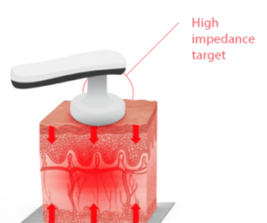 Tecar Therapy - Resistive