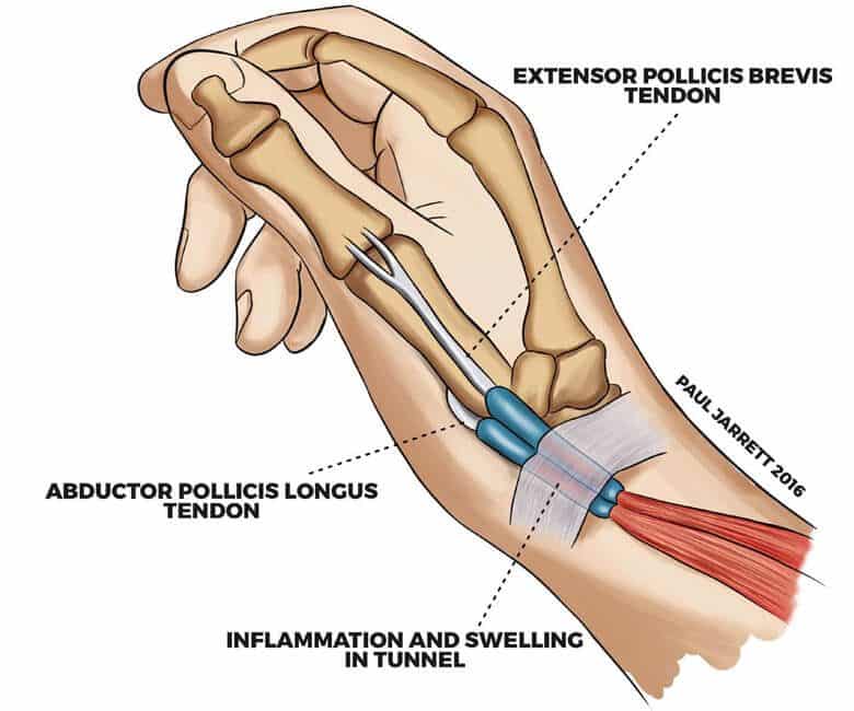 https://pauljarrett.info/treatments/hand-wrist/dequervains-tenosynovitis/